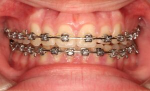 brackets-inicio.ortodoncia