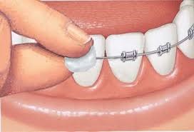 Tratamiento de ortodoncia con brackets: Urgencias y complicaciones más  comunes - Smileline Clinic