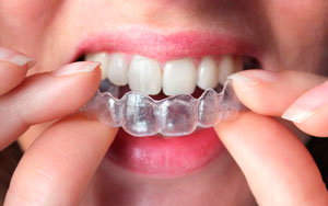 invisalign barcelona smileline clinic