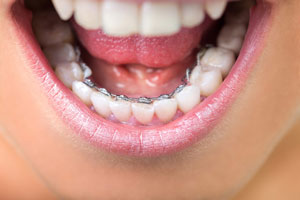 ortodoncia lingual smileline clinic barcelona