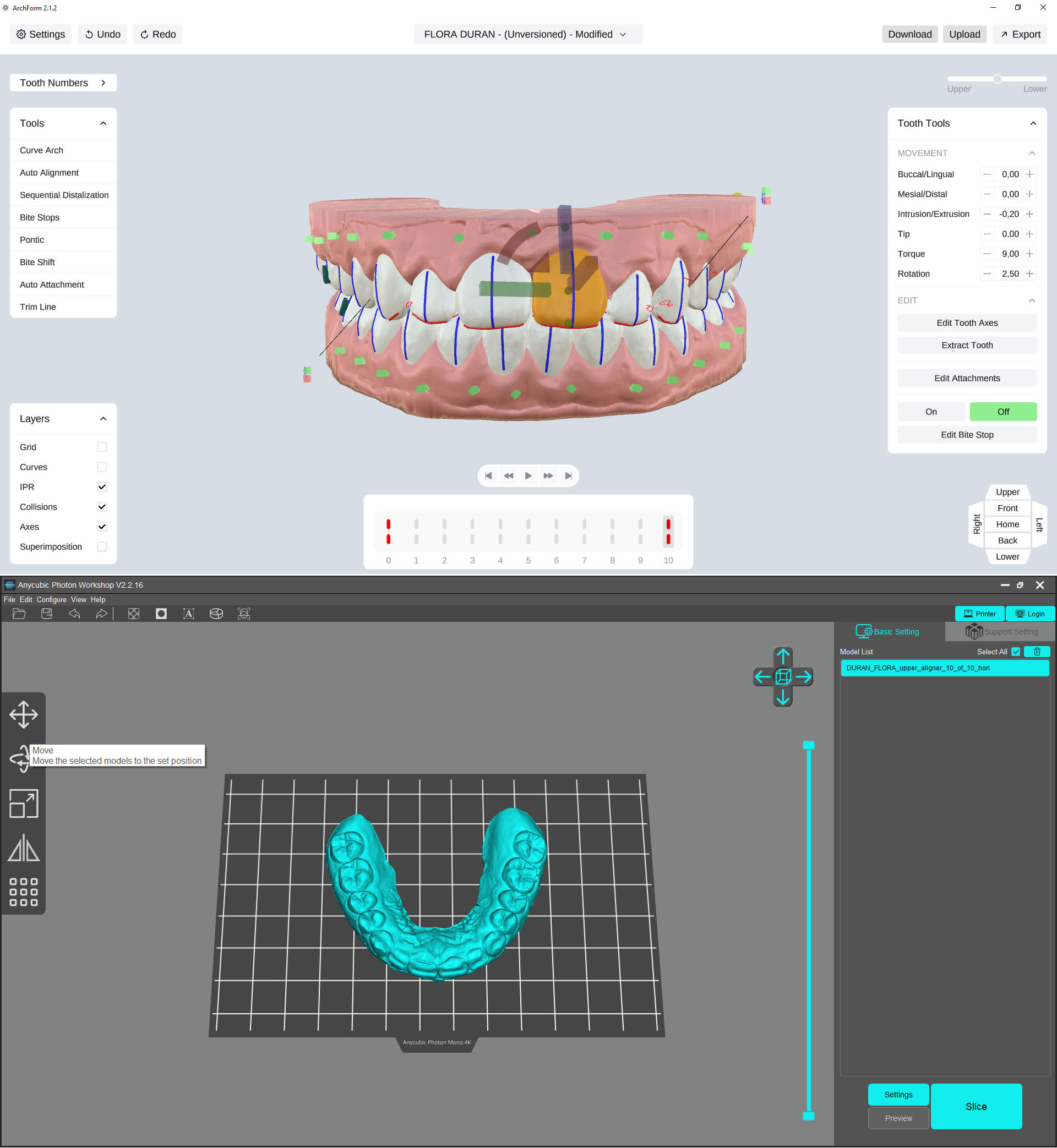 2. Utilizamos un software específico para SMILELINE para mover virtualmente cada uno de tus dientes en la posición idónea.