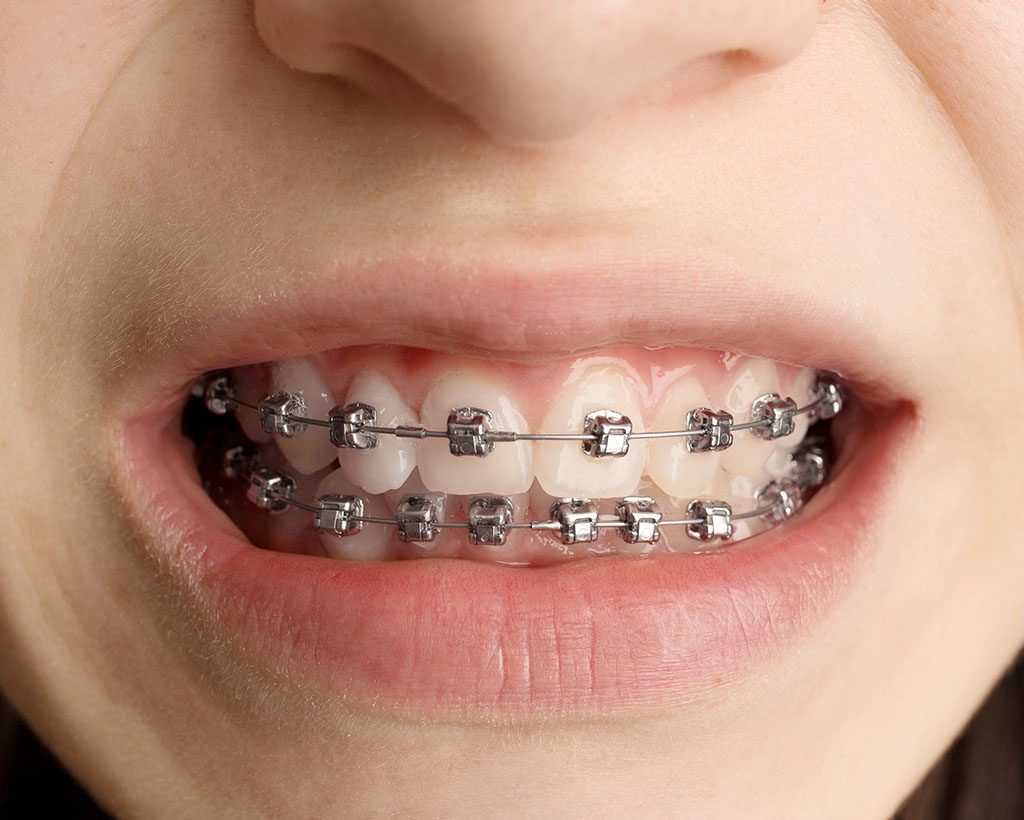 Brackets metálicos Smileline Clinic