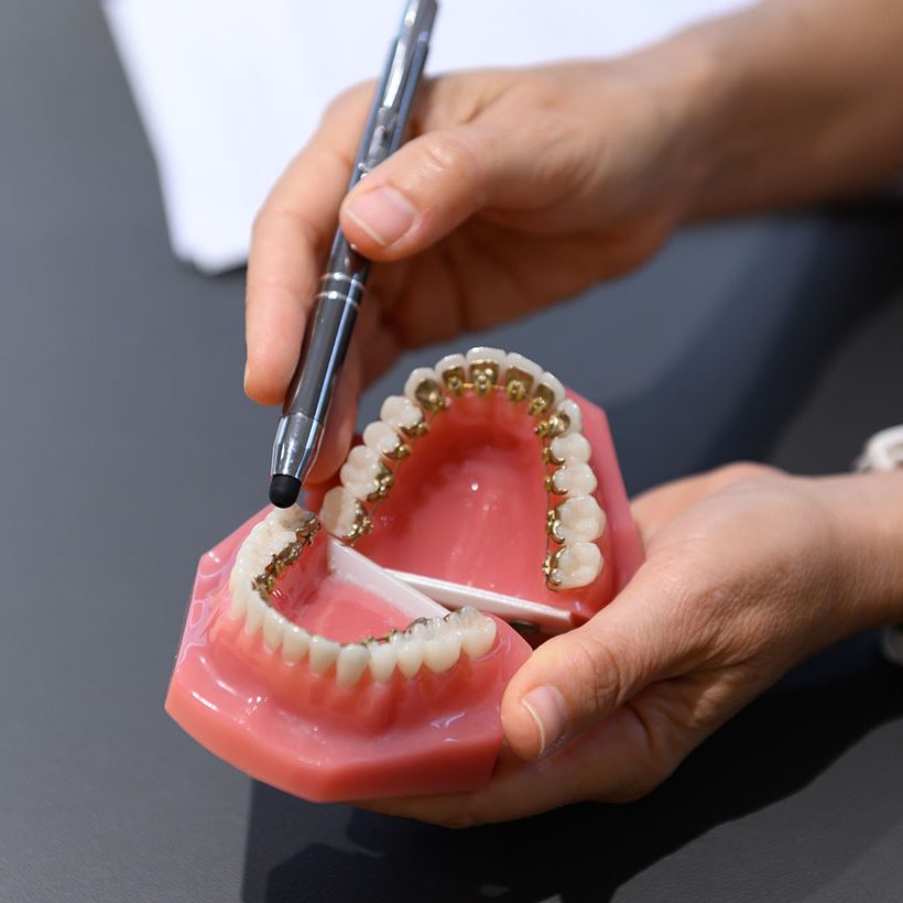 Brackets linguales Smileline Clinic